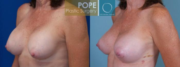Before & After Breast Capsulectomy Case 128 View #3 View in Orlando, FL
