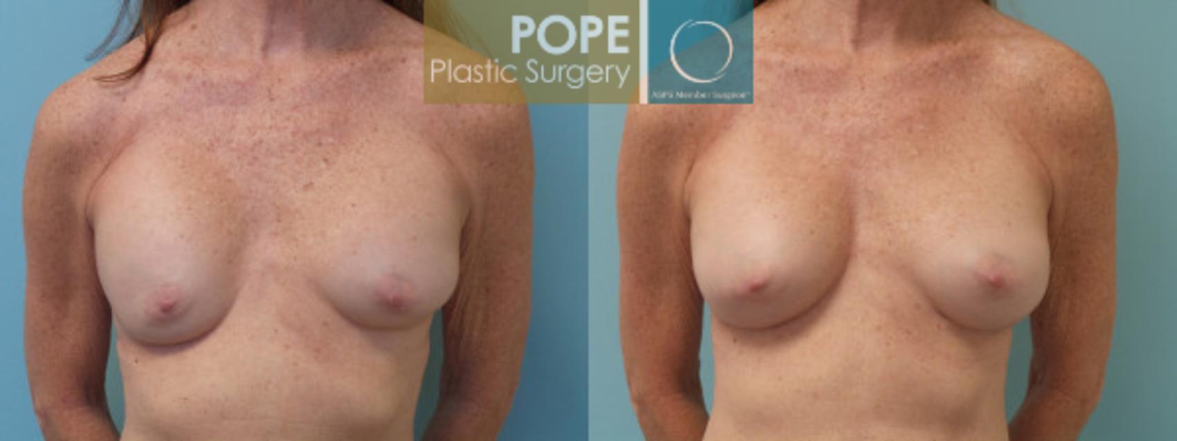 Before & After Breast Capsulectomy Case 130 View #1 View in Orlando, FL