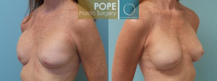 Before & After Breast Capsulectomy Case 130 View #2 View in Orlando, FL