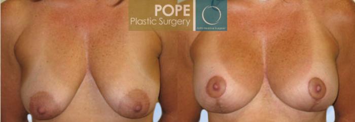 Before & After Breast Lift Case 131 View #1 View in Orlando, FL