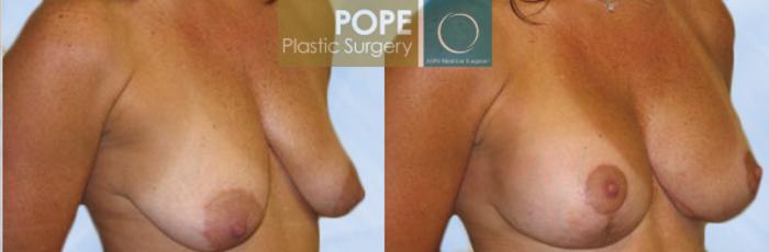 Before & After Breast Lift Case 131 View #2 View in Orlando, FL