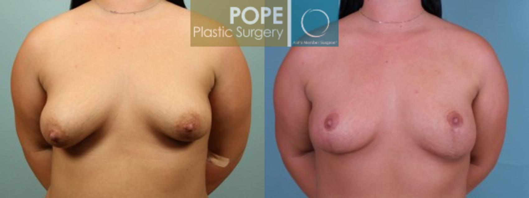 Before & After Breast Lift Case 132 View #1 View in Orlando, FL