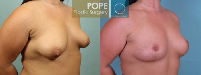 Before & After Breast Lift Case 132 View #2 View in Orlando, FL