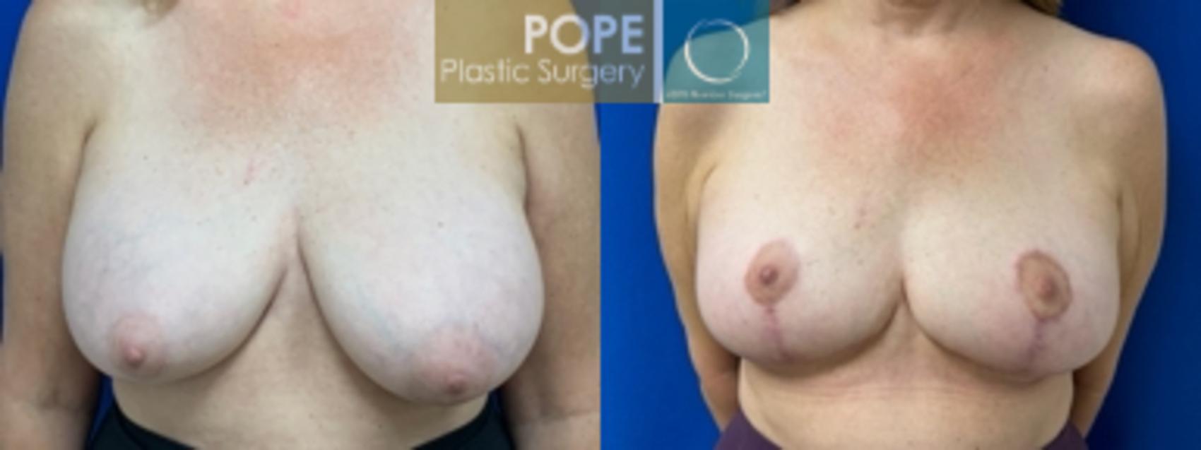 58 year old woman who had a mastopexy and implant replacement, with adjustment of implant volumes to achieve symmetry. (200cc on left, 270cc on right)