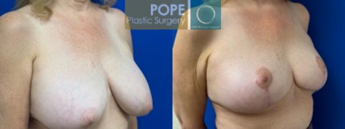  58 year old woman who had a mastopexy and implant replacement, with adjustment of implant volumes to achieve symmetry. (200cc on left, 270cc on right)