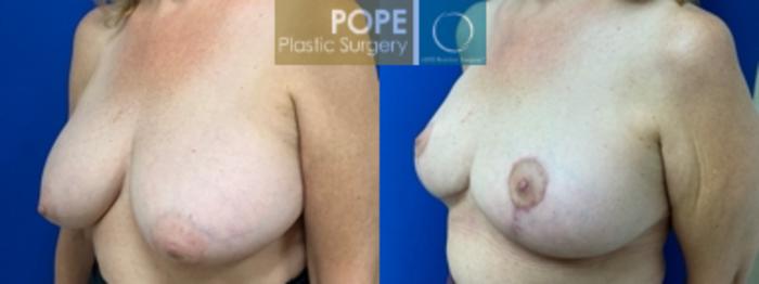  58 year old woman who had a mastopexy and implant replacement, with adjustment of implant volumes to achieve symmetry. (200cc on left, 270cc on right)