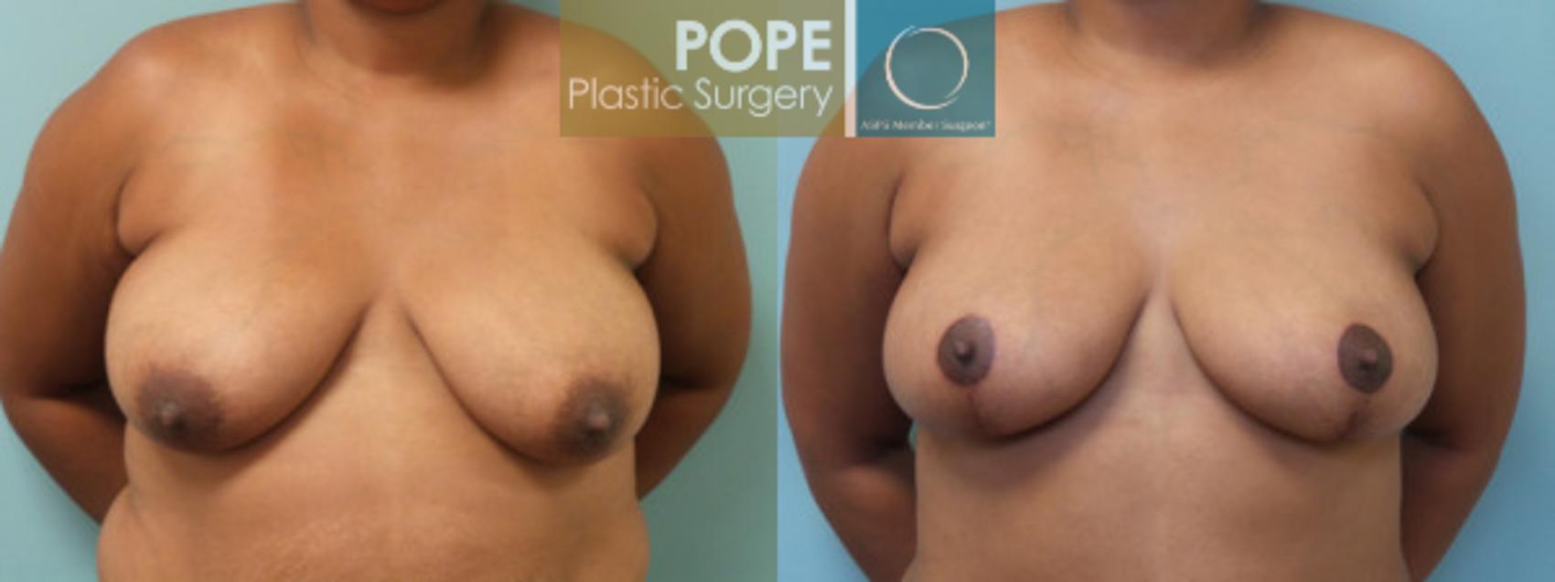Before & After Breast Lift Case 39 View #1 View in Orlando, FL