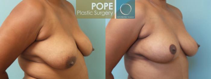 Before & After Breast Lift Case 39 View #2 View in Orlando, FL