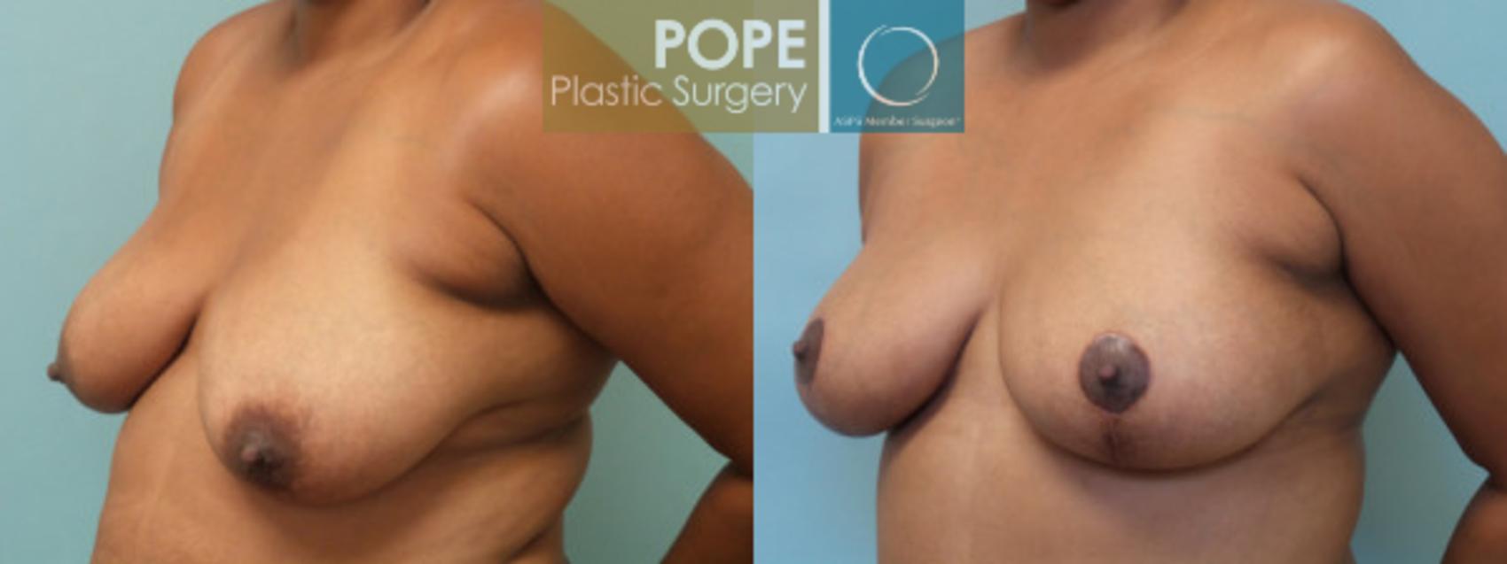 Before & After Breast Lift Case 39 View #3 View in Orlando, FL