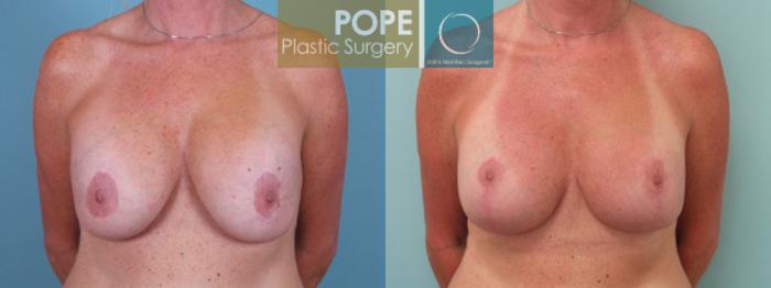 Before & After Breast Lift Case 41 View #1 View in Orlando, FL