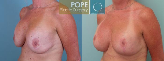 Before & After Breast Lift Case 41 View #2 View in Orlando, FL
