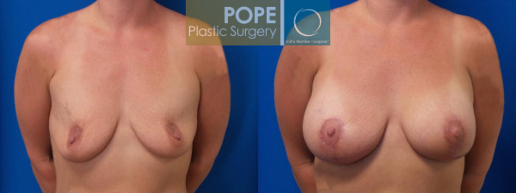 Before & After Breast Lift Case 43 View #1 View in Orlando, FL