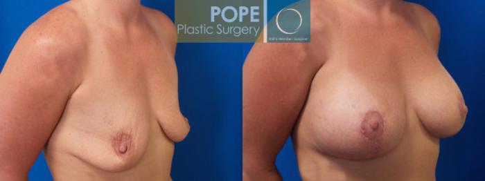 Before & After Breast Lift Case 43 View #2 View in Orlando, FL