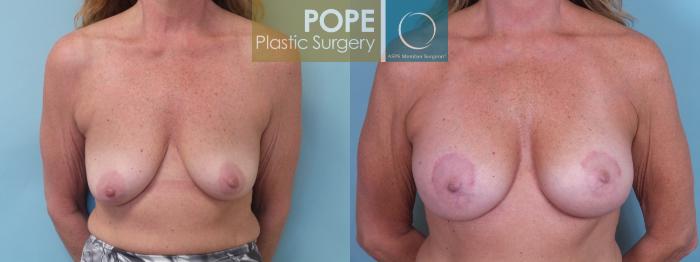 Before & After Breast Lift Case 77 View #1 View in Orlando, FL