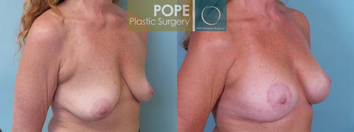 Before & After Breast Lift Case 77 View #2 View in Orlando, FL