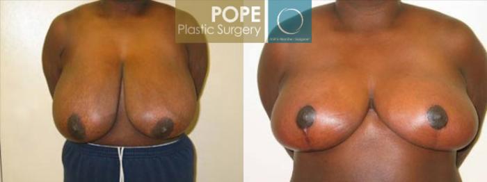 Before & After Breast Reduction Case 133 View #1 View in Orlando, FL