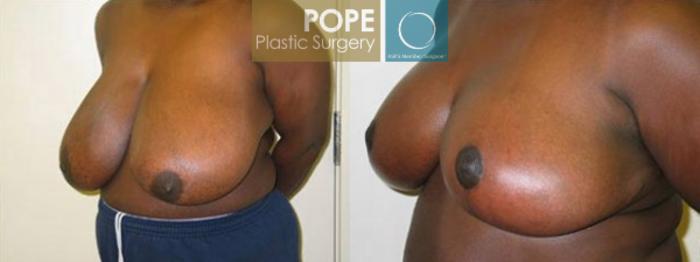 Before & After Breast Reduction Case 133 View #2 View in Orlando, FL