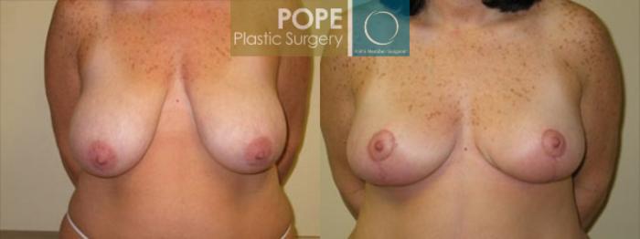 Before & After Breast Reduction Case 134 View #1 View in Orlando, FL