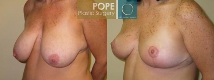 Before & After Breast Reduction Case 134 View #2 View in Orlando, FL