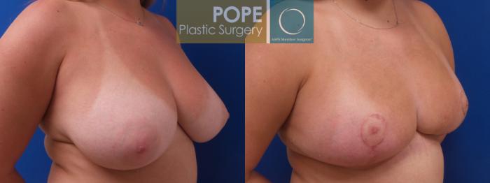 Before & After Breast Reduction Case 189 Left Oblique View in Orlando, FL