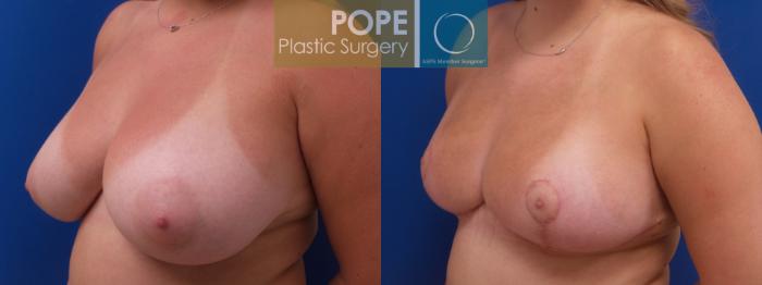 Before & After Breast Reduction Case 189 Right Oblique View in Orlando, FL