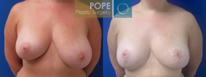 34 year-old-woman who had breast reduction