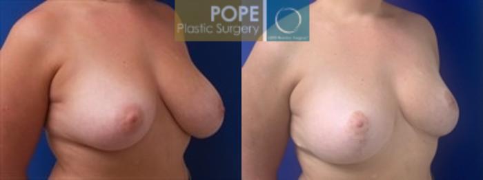 Before & After Breast Reduction Case 199 Left Oblique View in Orlando, FL