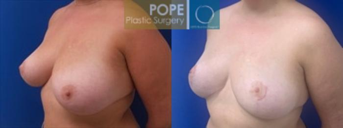 Before & After Breast Reduction Case 199 Right Oblique View in Orlando, FL