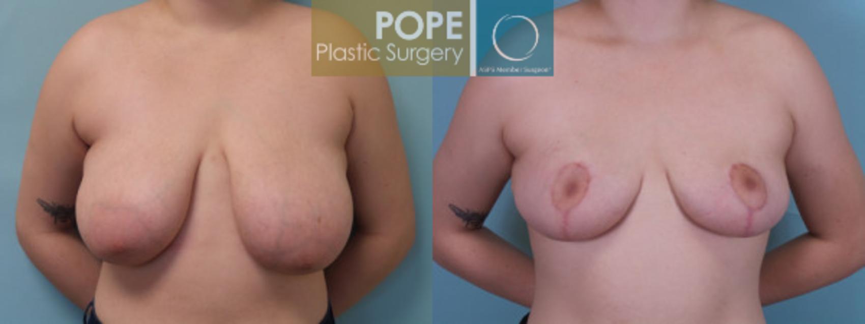 Before & After Breast Reduction Case 44 View #1 View in Orlando, FL