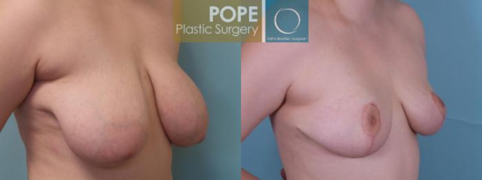 Before & After Breast Reduction Case 44 View #2 View in Orlando, FL