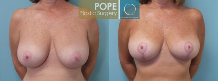 Before & After Breast Reduction Case 45 View #1 View in Orlando, FL