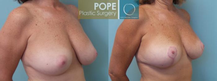 Before & After Breast Reduction Case 45 View #2 View in Orlando, FL