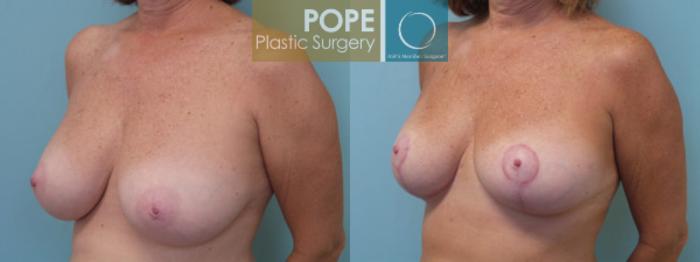 Before & After Breast Reduction Case 45 View #3 View in Orlando, FL