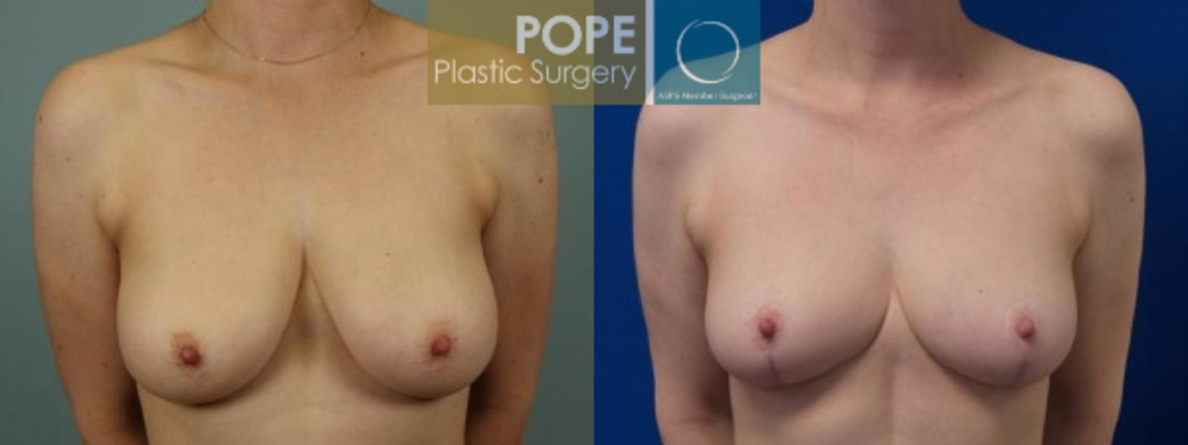 Before & After Breast Reduction Case 46 View #1 View in Orlando, FL