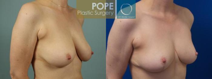 Before & After Breast Reduction Case 46 View #2 View in Orlando, FL