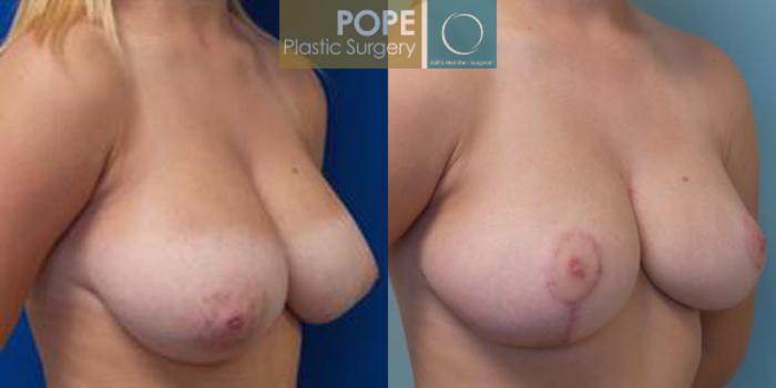 Before & After Breast Reduction Case 47 View #2 View in Orlando, FL