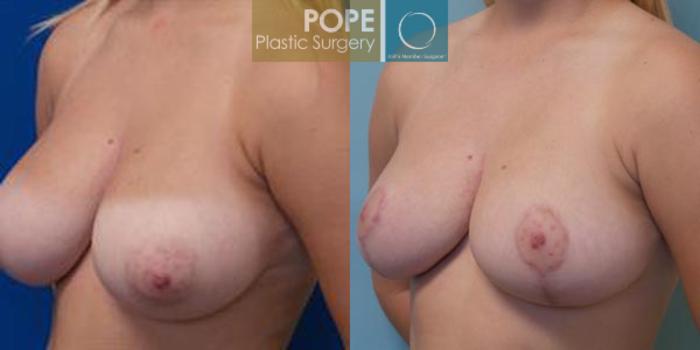 Before & After Breast Reduction Case 47 View #3 View in Orlando, FL