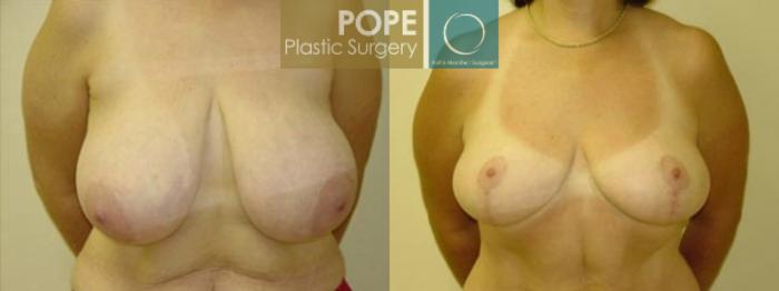 Before & After Breast Reduction Case 48 View #1 View in Orlando, FL
