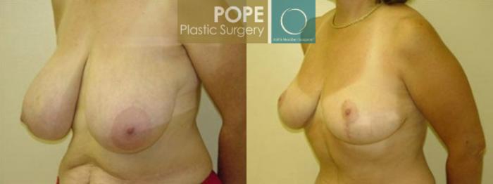 Before & After Breast Reduction Case 48 View #2 View in Orlando, FL