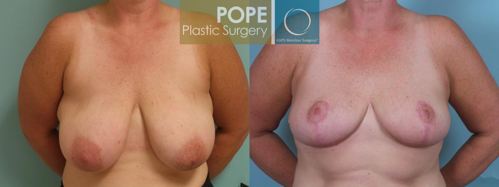 Before & After Breast Reduction Case 73 View #1 View in Orlando, FL