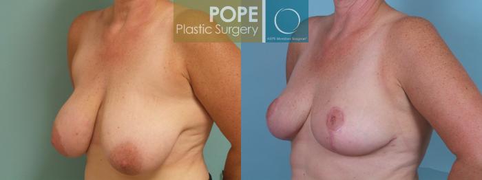 Before & After Breast Reduction Case 73 View #2 View in Orlando, FL