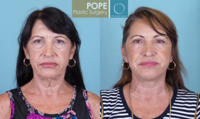 Before & After Brow Lift Case 28 View #1 View in Orlando, FL