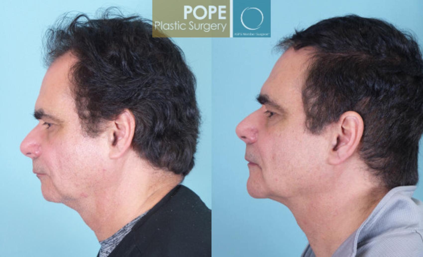 Before & After Chin Augmentation Case 135 View #1 View in Orlando, FL