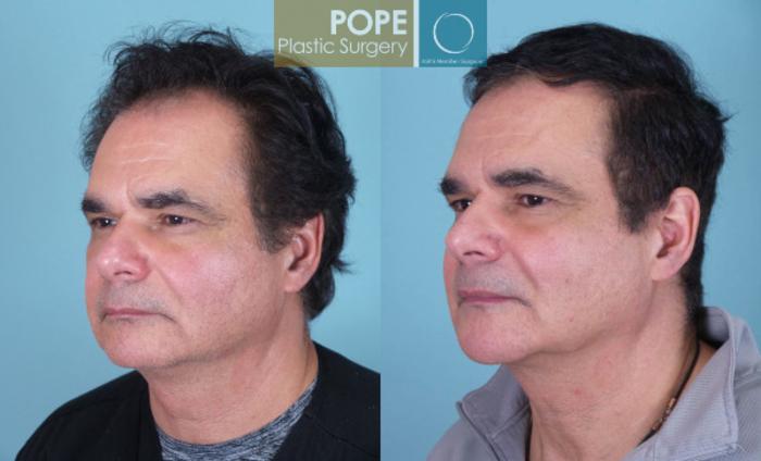 Before & After Chin Augmentation Case 135 View #2 View in Orlando, FL