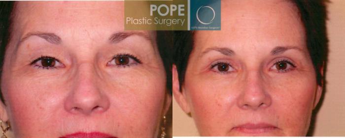 Before & After Eyelid Surgery Case 106 View #2 View in Orlando, FL