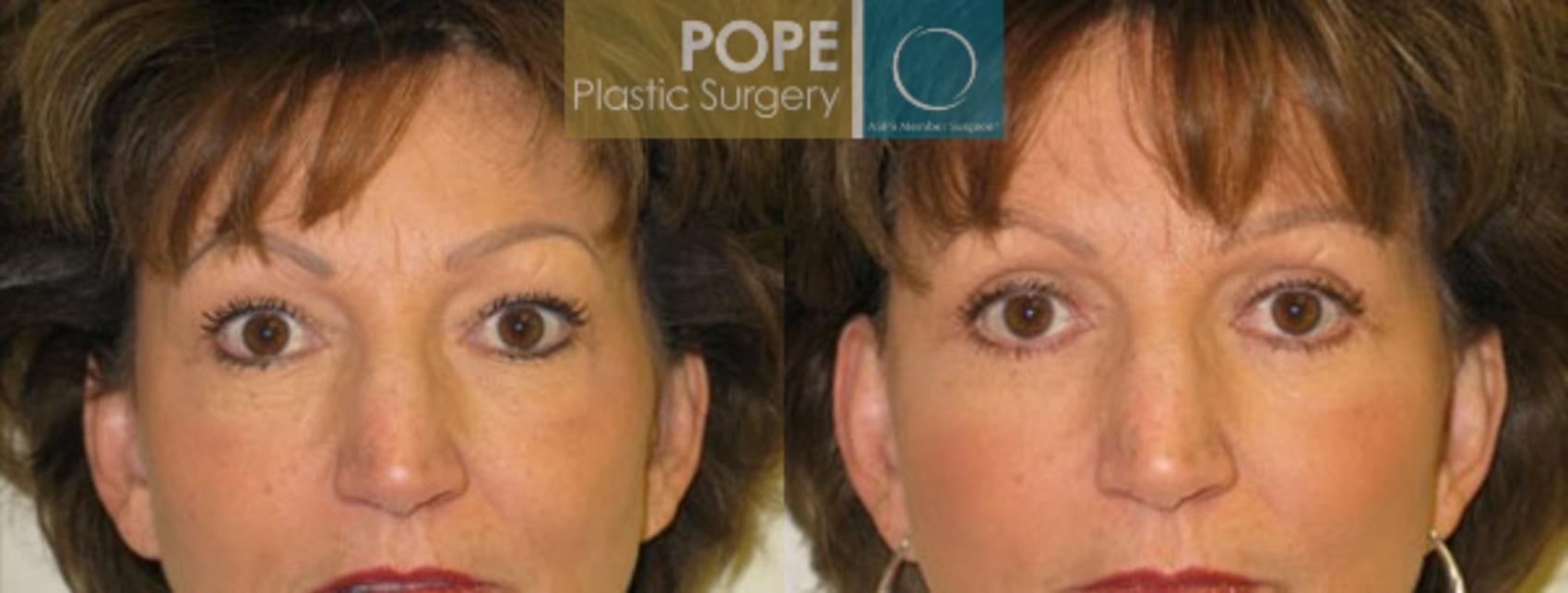Before & After Eyelid Surgery Case 136 View #1 View in Orlando, FL