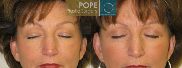 Before & After Eyelid Surgery Case 136 View #2 View in Orlando, FL