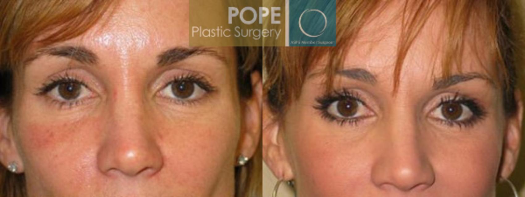 Before & After Eyelid Surgery Case 137 View #1 View in Orlando, FL