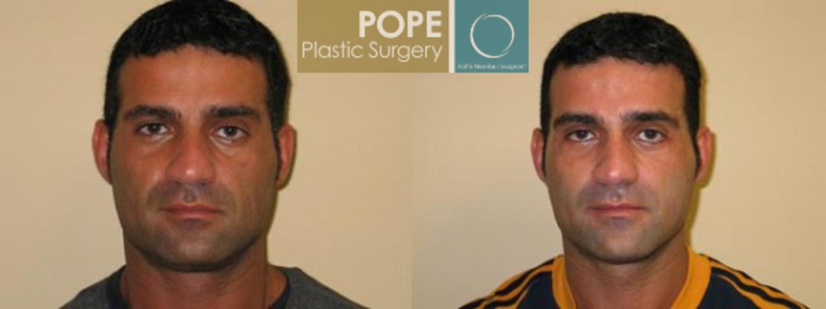 Before & After Eyelid Surgery Case 138 View #1 View in Orlando, FL
