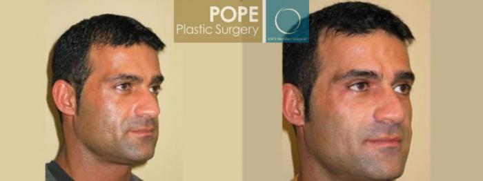 Before & After Eyelid Surgery Case 138 View #2 View in Orlando, FL